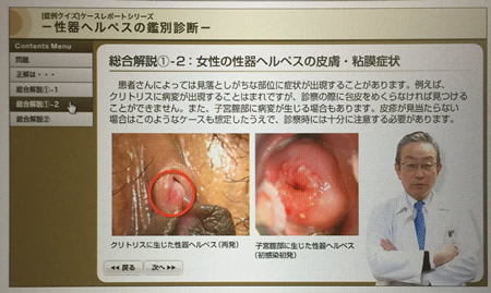 市販薬 精器ヘルペス女性早く治す