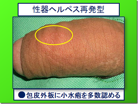 ヘルペス 画像 性器 性器ヘルペスの実践的な診断手順