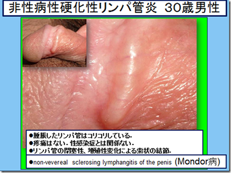 チ ん コ 黒ずみ 病気