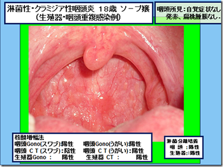 クラミジア症状写真