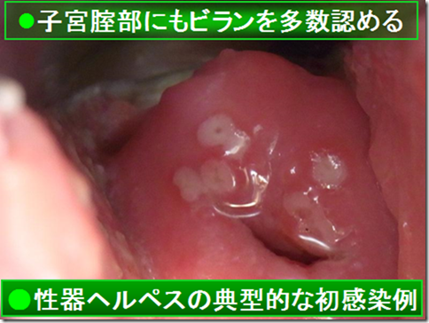 悪化 性器 ヘルペス