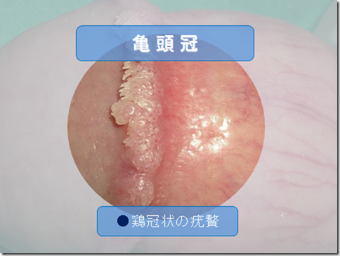 放置 コンジローマ 尖圭コンジローマとは[感染率80%？]感染経路から症状･病院まで