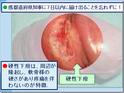 溶連菌 気づか ず 放置