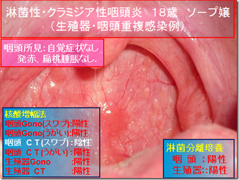 クラミジア 原因 ストレス